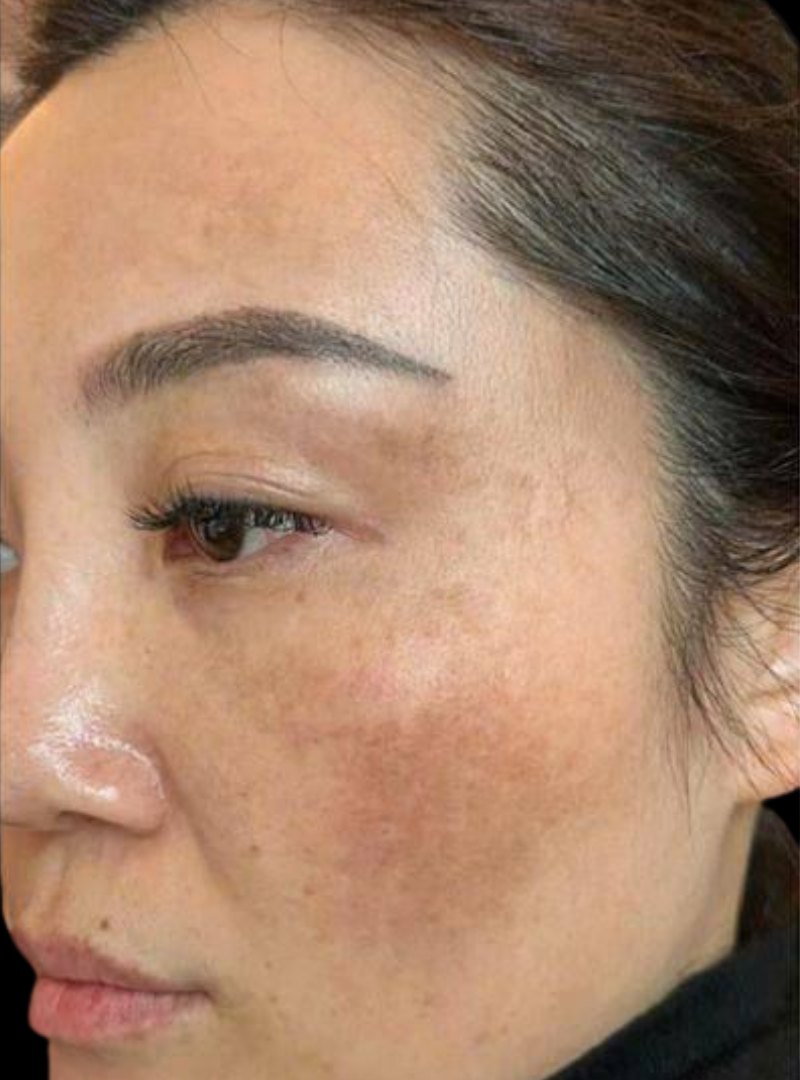 Before chemical peel